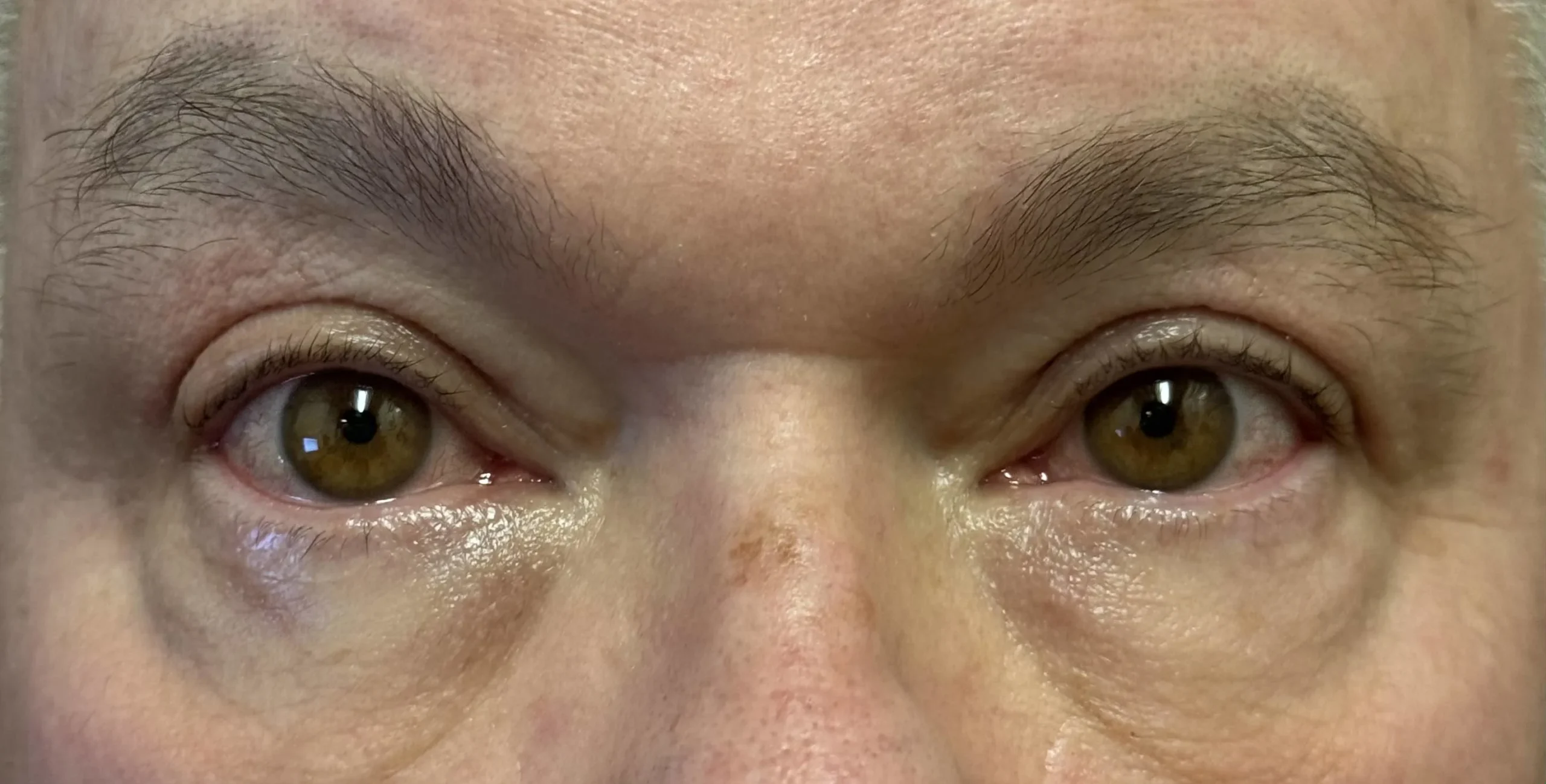 After Blepharoplasty Treatment in Hoboken, NJ, and Weehawken, NJ | 1Aesthetic