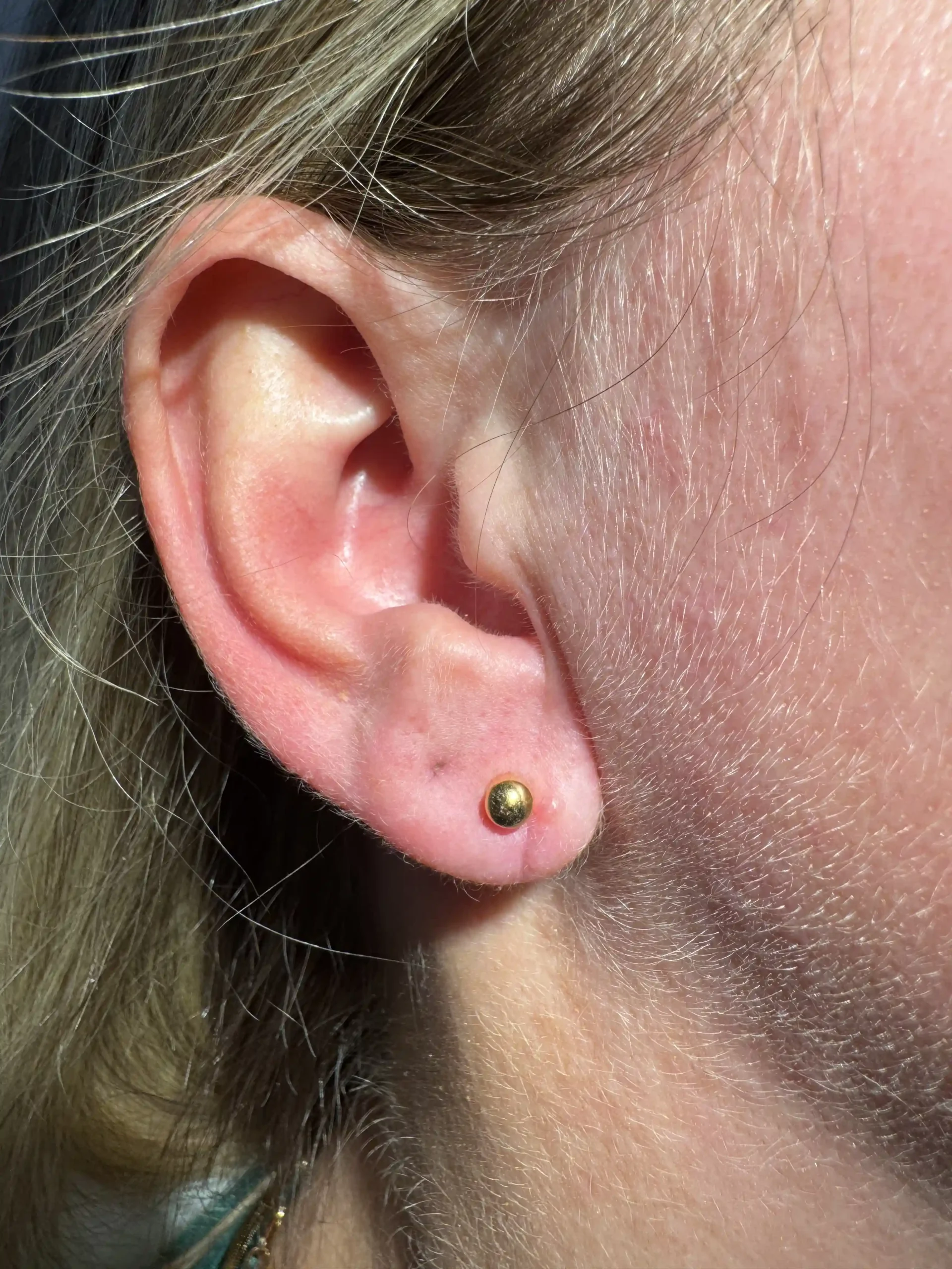 Earlobe Repair After Treatment in Hoboken and Weehawken, NJ | 1Aesthetic