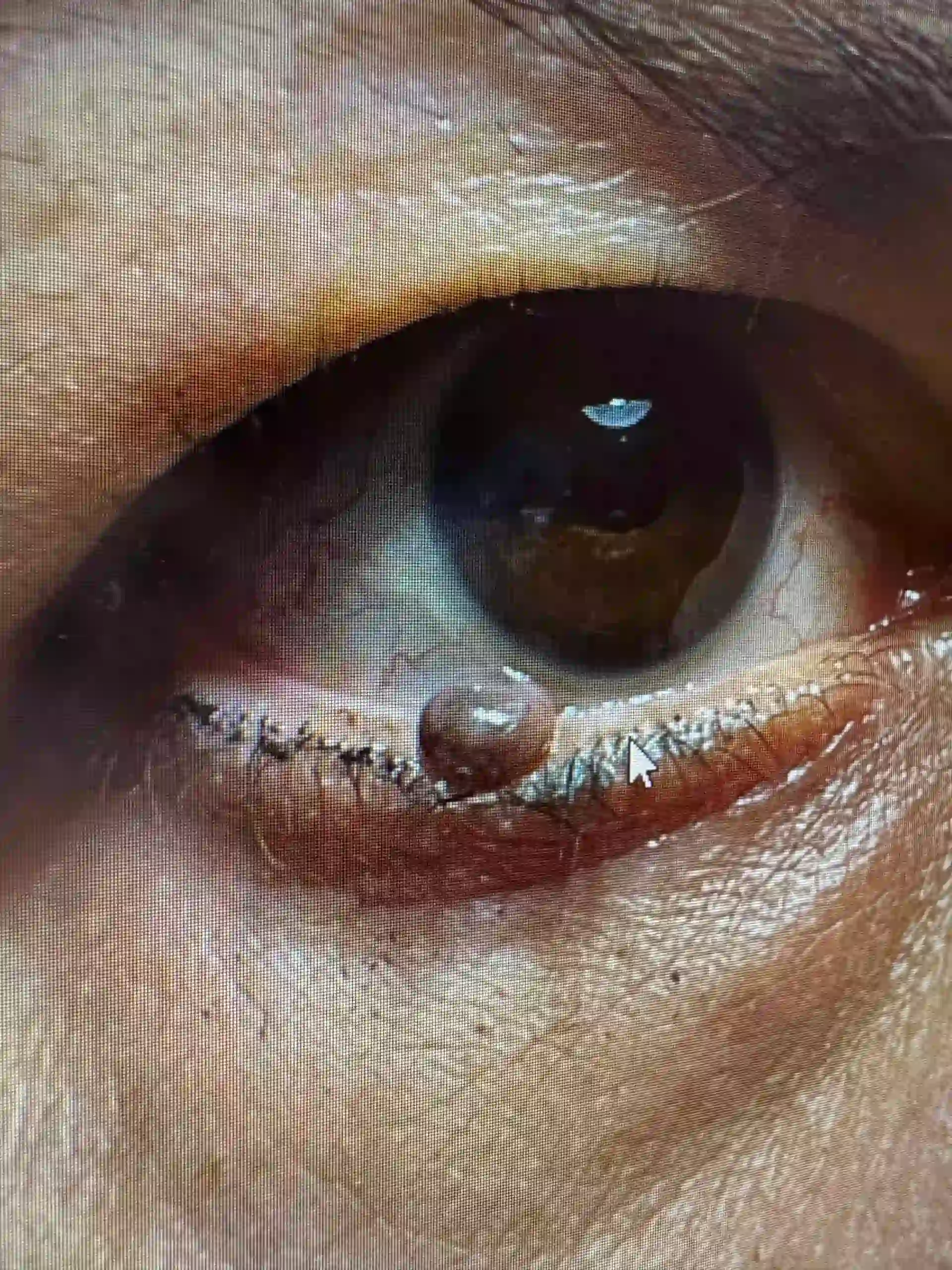 Before Mole Removal Treatment | Hoboken and Weehawken NJ | 1Aesthetic Before Mole Removal Treatment | Hoboken and Weehawken NJ | 1Aesthetic