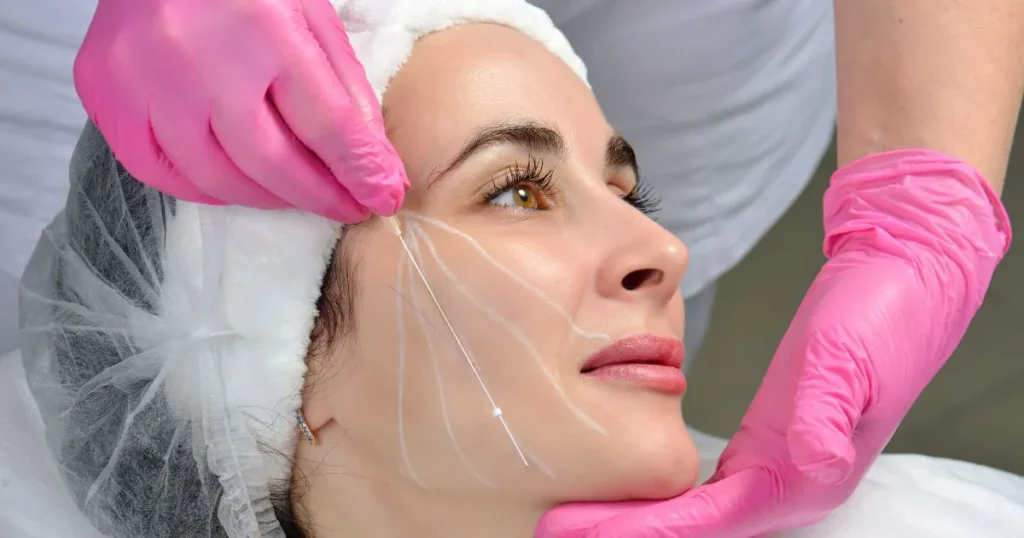 Thread Lift procedure in Hoboken, NJ and Weehawken, NJ for skin tightening