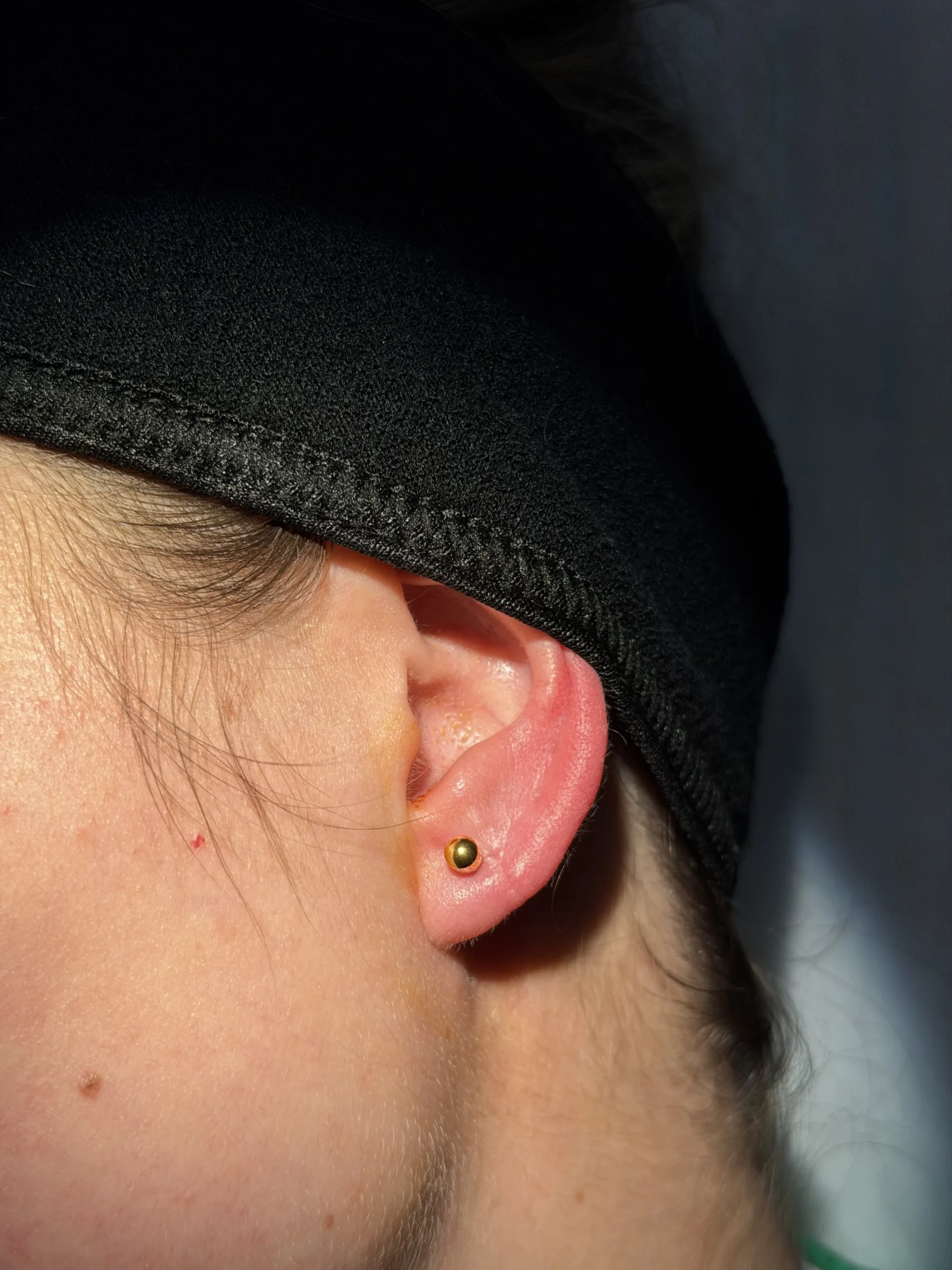 After Earlobe Treatment at 1Aesthetics in Hoboken and Weehawken, NJ