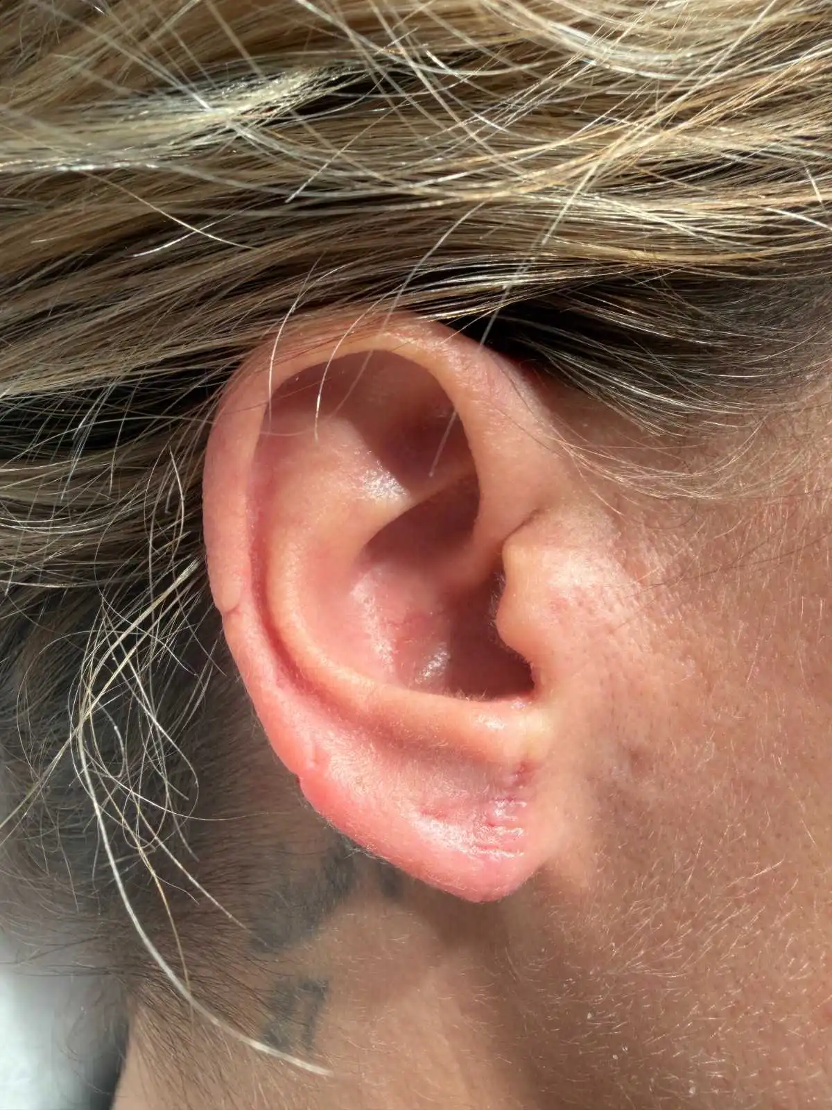 Earlobe Repair Before After