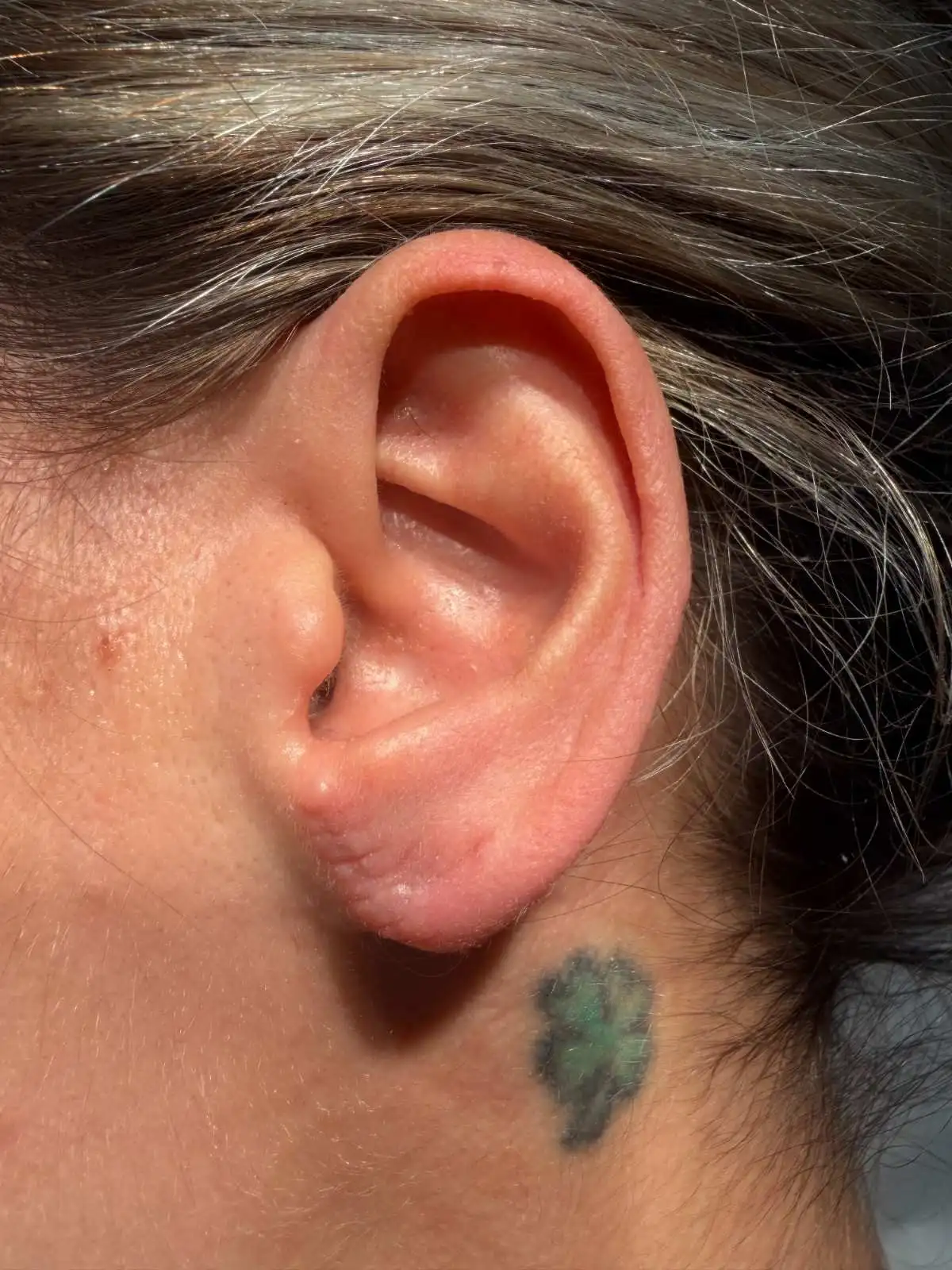 Earlobe Repair Before After