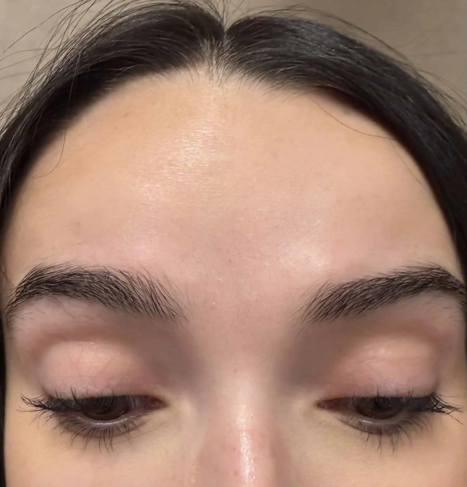 Botox Treatment in Hoboken, NJ at 1Aesthetics