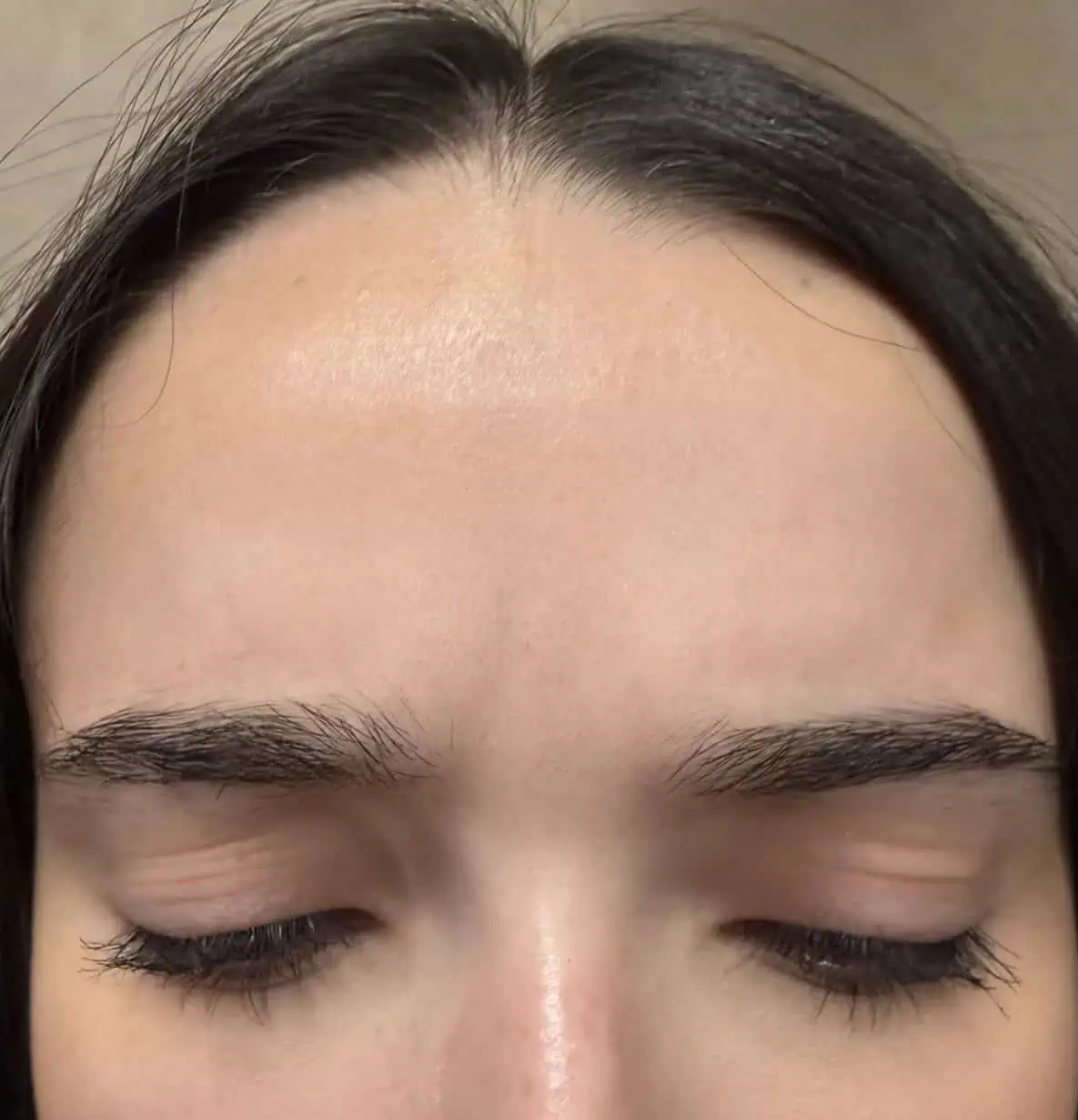 Botox treatment in Hoboken, NJ at 1Aesthetics