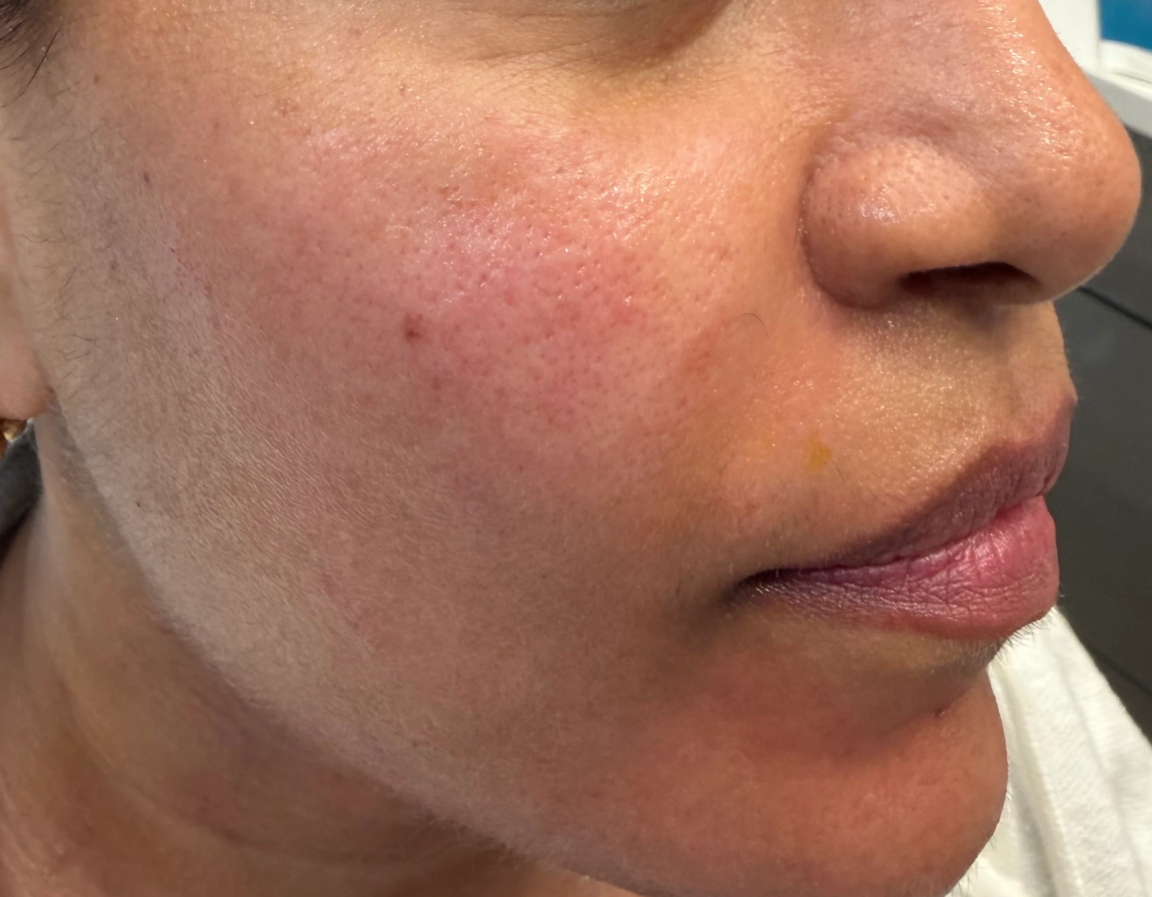 After Scluptra Treatment Result in Hoboken, NJ at 1Aesthetics