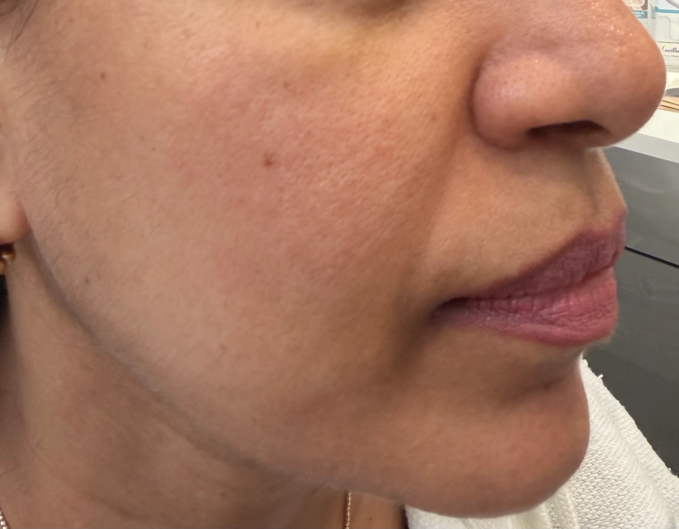 Sculptra Before New 1 Before Scluptra Treatment Result in Hoboken, NJ at 1Aesthetics