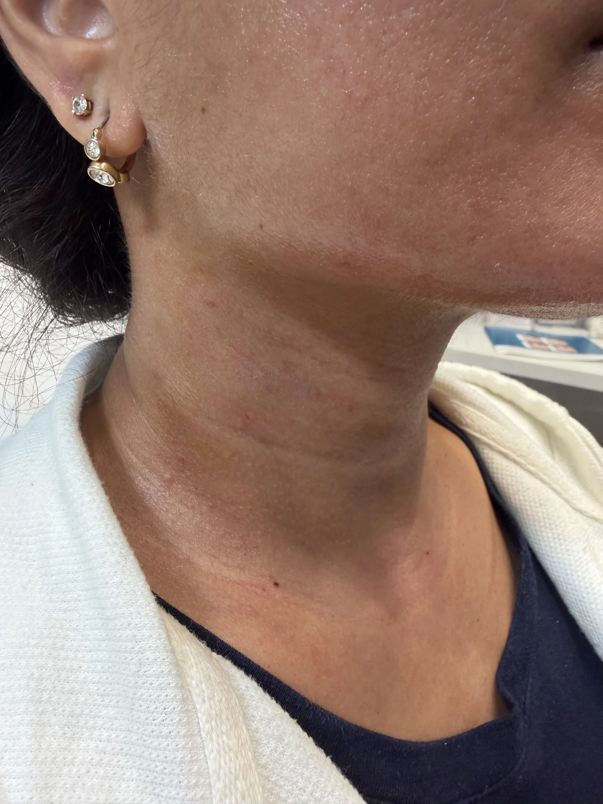 After Scluptra Neck Treatment Result in Hoboken, NJ at 1Aesthetics