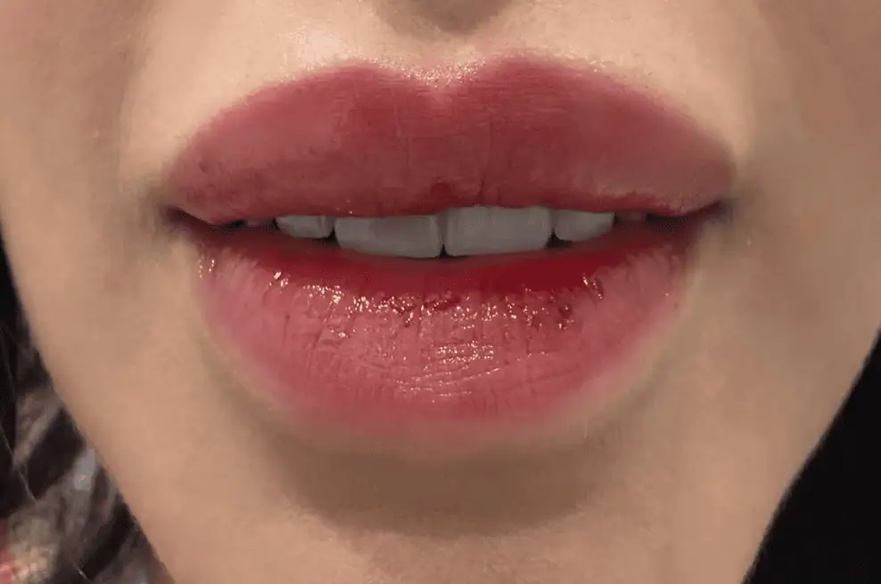 1aesthetic-Lip Flip-after-img-2