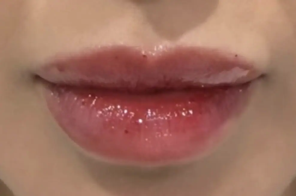 1aesthetic-Lip Flip-before-img-1 1aesthetic-Lip Flip-before-img-1