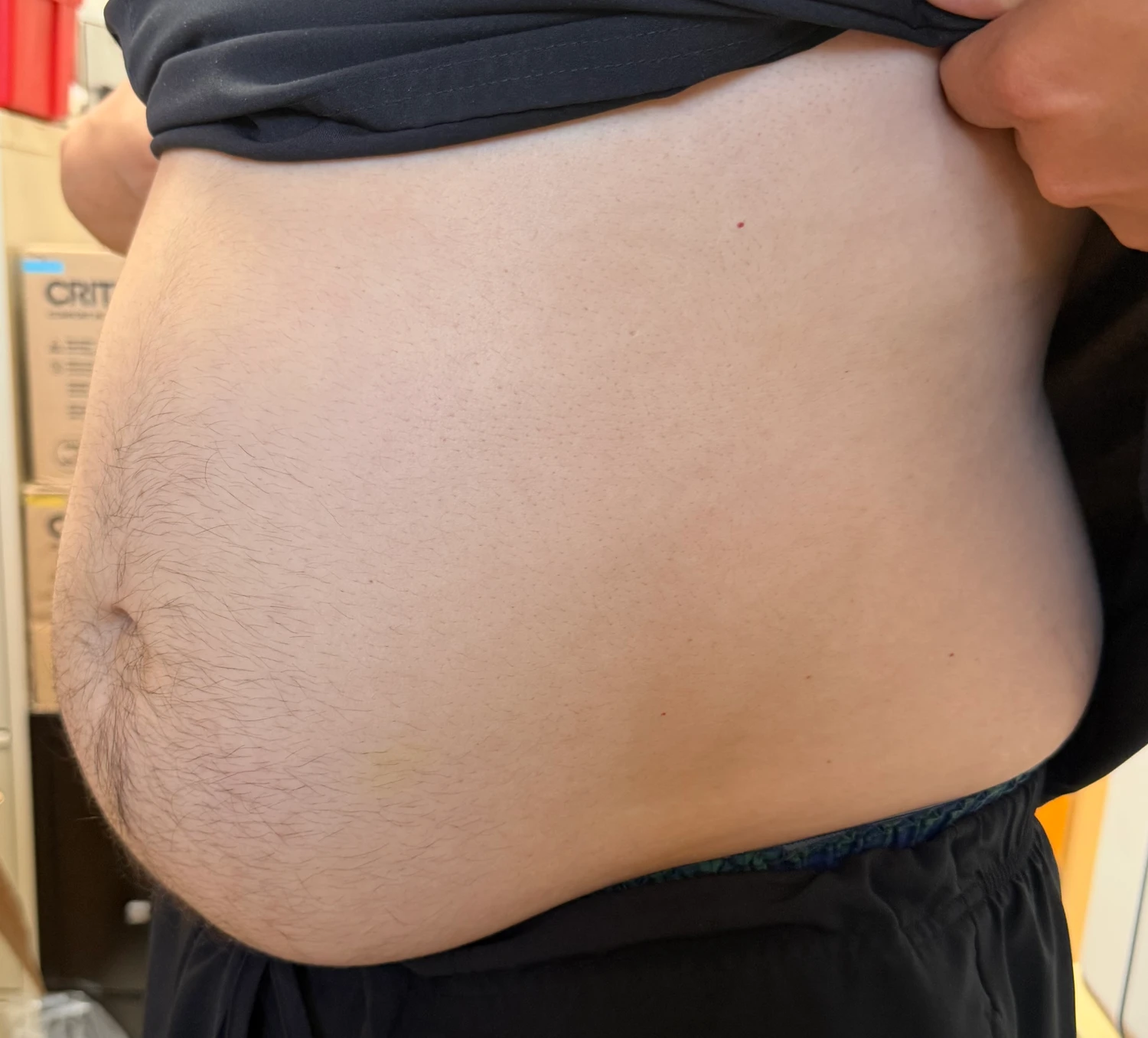 Tirzepatide before and after b