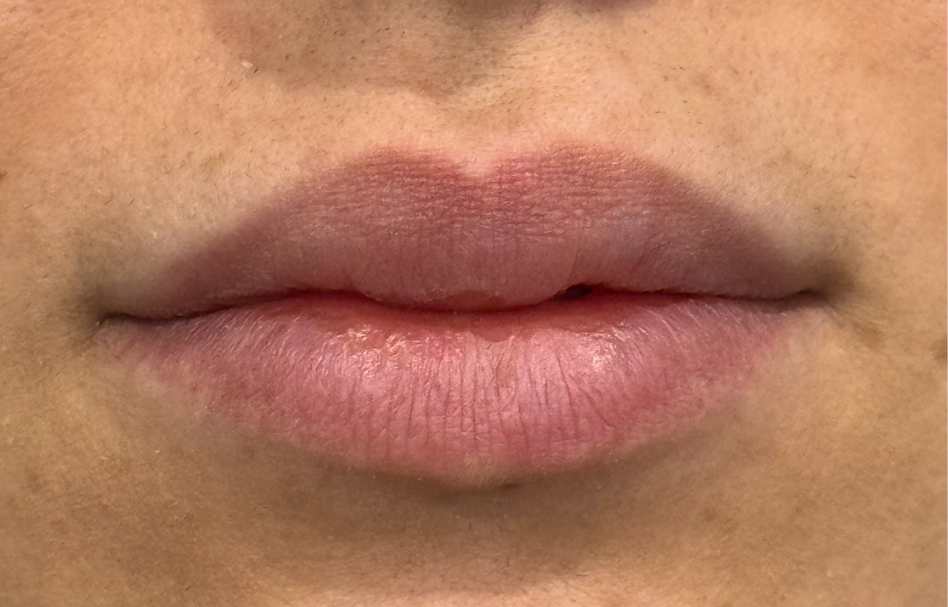 1aesthetic – lip filler before 1aesthetic - lip filler before