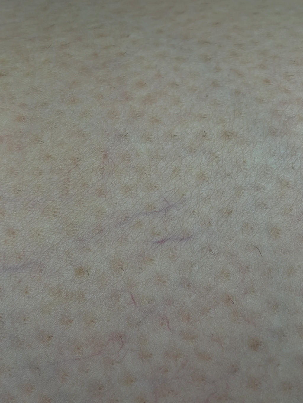 Before-Laser-Vein-Removal Before-Laser-Vein-Removal
