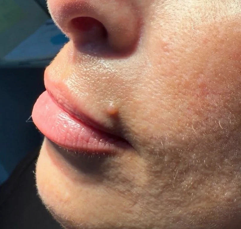 Before-Lip-Filler Before-Lip-Filler
