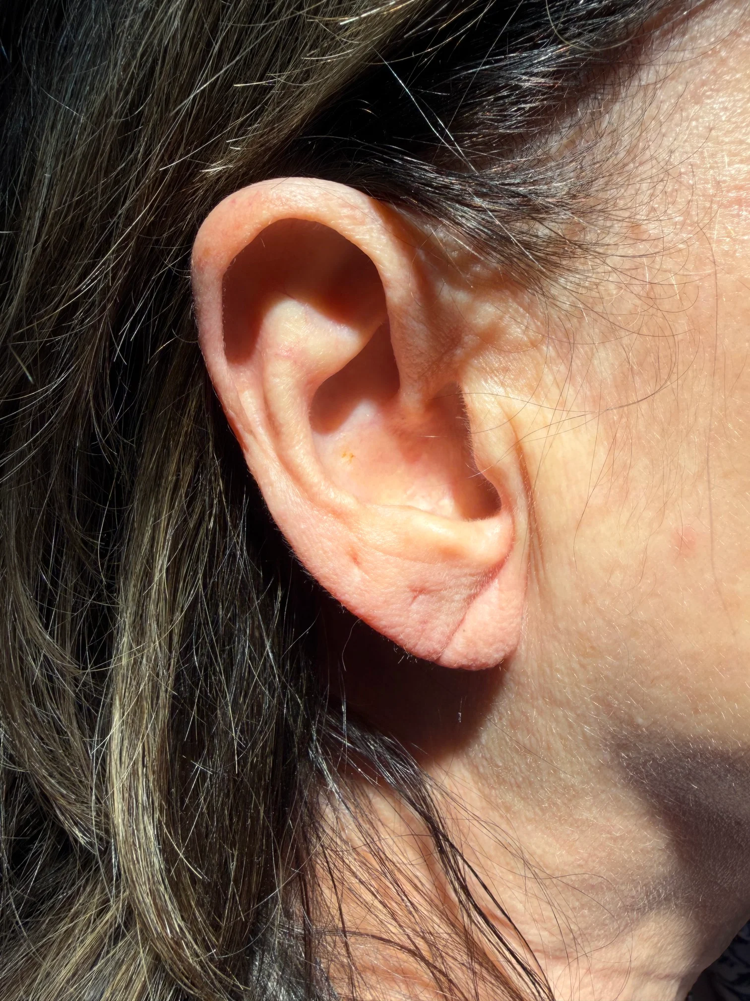 earlobe-filler-before-1 Before earlobe filler treatment - close-up of ear showing pre-treatment condition