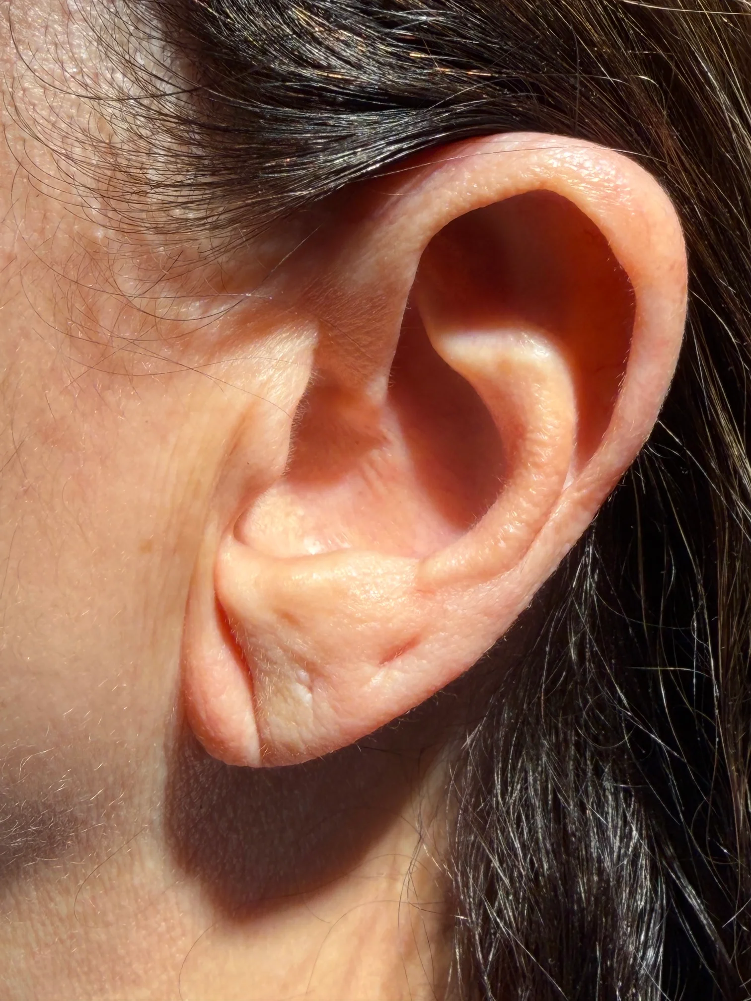 earlobe-filler-before-2 Before earlobe filler treatment - second patient close-up of ear showing pre-treatment condition