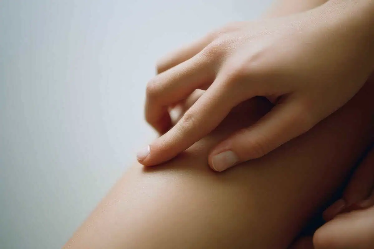 Early signs of lipedema affecting the legs