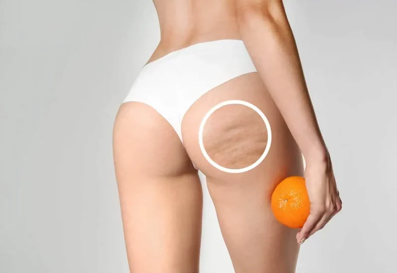 Cellulite Laser Treatment in Hoboken, NJ and Weehawken, NJ | 1aesthetics