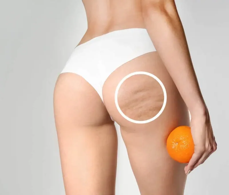 Cellulite Laser Treatment in Hoboken, NJ and Weehawken, NJ | 1aesthetics