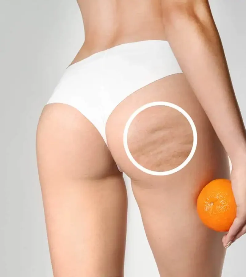 Cellulite Laser Treatment in Hoboken, NJ and Weehawken, NJ | 1aesthetics