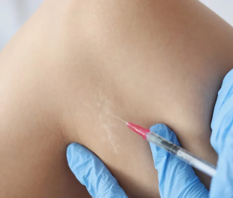 Steroid injection in Hoboken, NJ and Weehawken, NJ | 1aesthetics
