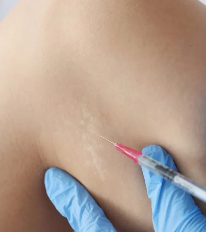 Steroid injection in Hoboken, NJ and Weehawken, NJ | 1aesthetics