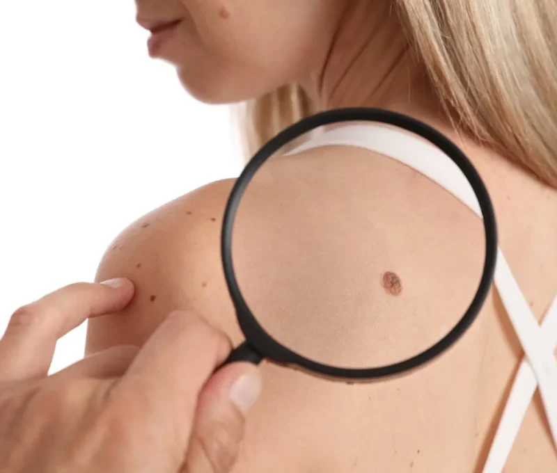 Birthmark Removal | Hoboken and Weehawken NJ | 1Aesthetic