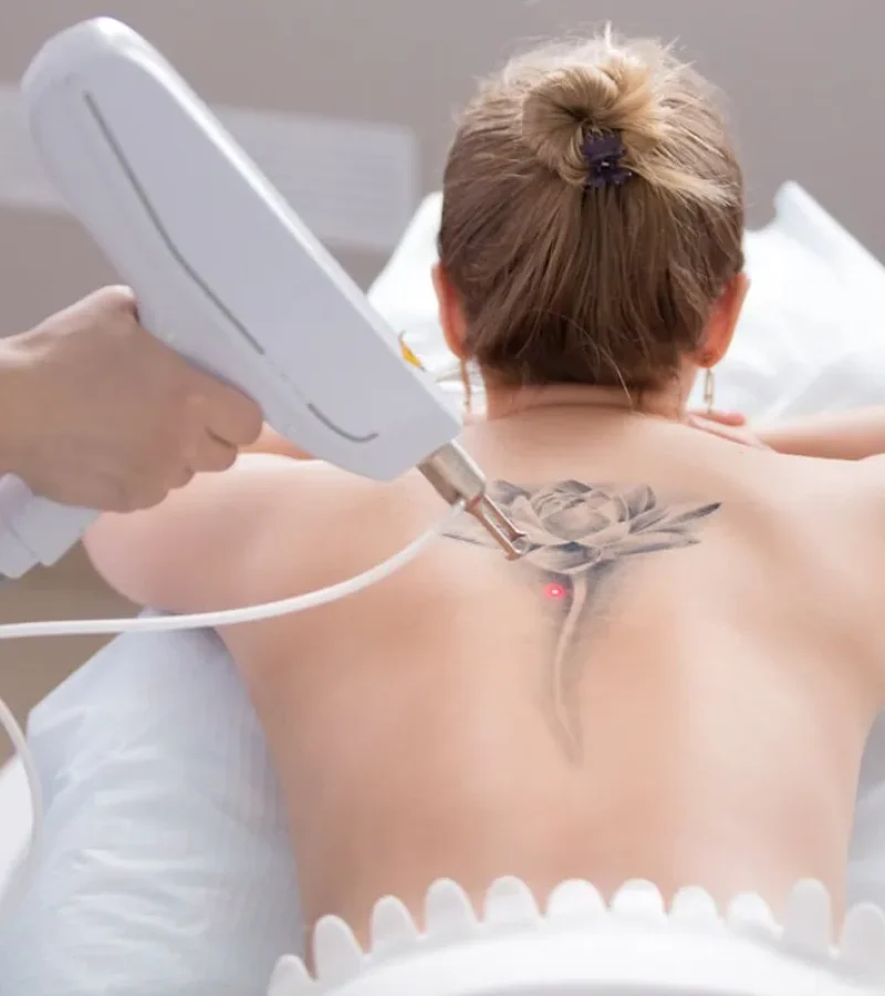 Laser Tattoo Removal in Hoboken, NJ and Weehawken, NJ | 1aesthetics