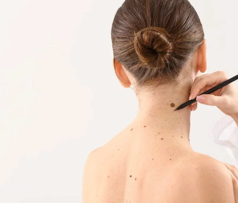 Mple and skin tag removal in Hoboken, NJ and Weehawken, NJ | 1aesthetics