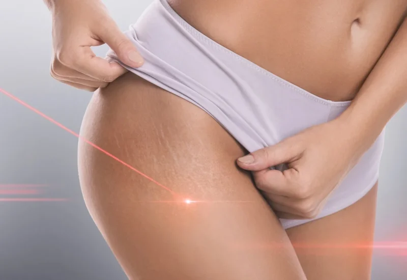 Stretch mark laser in Hoboken, NJ and Weehawken, NJ | 1aesthetics