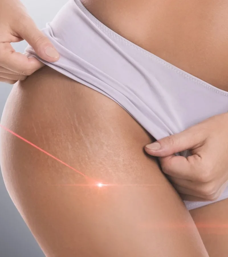 Stretch mark laser in Hoboken, NJ and Weehawken, NJ | 1aesthetics